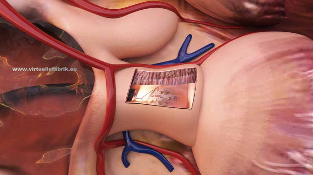 medizinische 3d-visualisierung für Nierenstein Operation